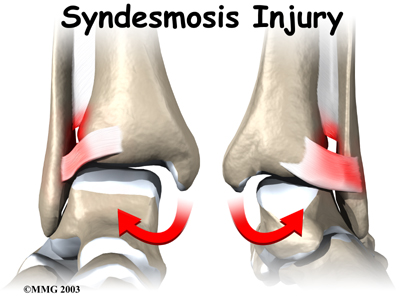 Syndesmosis Injury